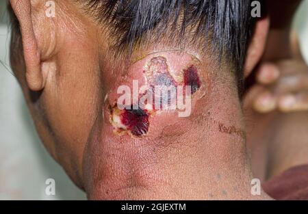 Großer Abszess mit umgebender Cellulitis oder Staphylokokken, Streptokokken-Hautinfektion am Hals einer asiatischen burmesischen Patientin. Stockfoto