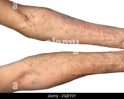 Krätze-Befall im oberen Teil des südostasiatischen, birmanischen Mannes. Eine ansteckende Hauterkrankung, die durch Milben verursacht wird. Stockfoto