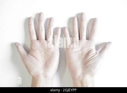 Blasse Palmaroberfläche beider Hände. Anämische Hände eines asiatischen, chinesischen Mannes. Stockfoto