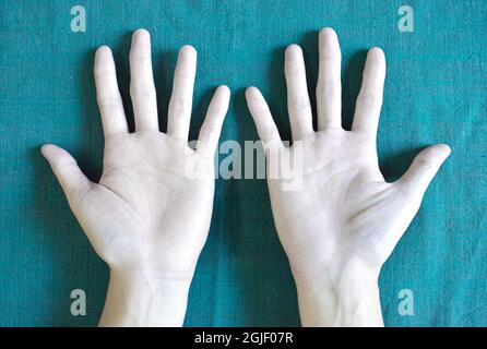 Blasse Palmaroberfläche beider Hände. Anämische Hände eines asiatischen, chinesischen Mannes. Stockfoto