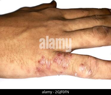 Krätze-Befall mit sekundärer oder überlagerter bakterieller Infektion in der Hand des südostasiatischen, burmesischen Kindes. Eine ansteckende Hauterkrankung verursachte b Stockfoto
