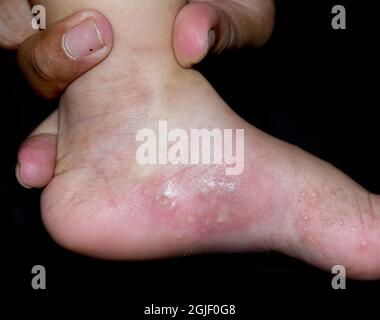 Krätze Befall mit sekundären oder überlagerten bakteriellen Infektionen und Pusteln im Fuß des südostasiatischen, burmesischen Kindes. Eine ansteckende Hautkonditione Stockfoto