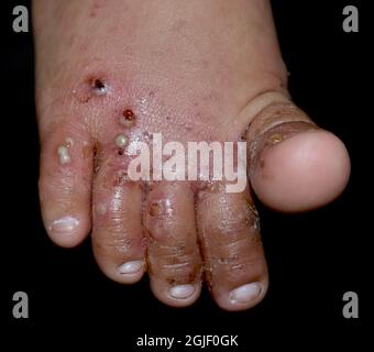 Krätze Befall mit sekundären oder überlagerten bakteriellen Infektionen und Pusteln im Fuß des südostasiatischen, burmesischen Kindes. Eine ansteckende Hautkonditione Stockfoto