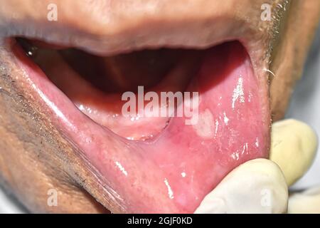 Aphthous Ulcus oder Stress Ulcus im Mund von asiatischen, Kind. Stockfoto