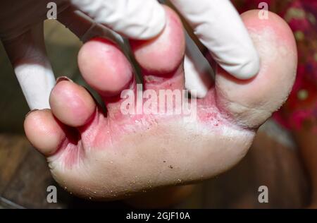 Pilzinfektion genannt Tinea pedis am Fuß der asiatischen Frau. Es handelt sich um eine juckende Läsion. Stockfoto