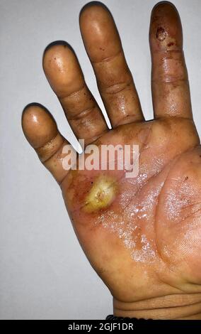 Abszess mit umgebender Cellulitis oder Staphylokokken, Streptokokken-Hautinfektion bei einem männlichen asiatischen Patienten aus Burma. Stockfoto