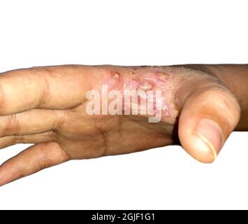 Krätze Befall mit sekundären oder überlagerten bakteriellen Infektionen und Pusteln in der Hand von südostasiatischen, birmanischen Kindern. Eine ansteckende Hautkonditione Stockfoto