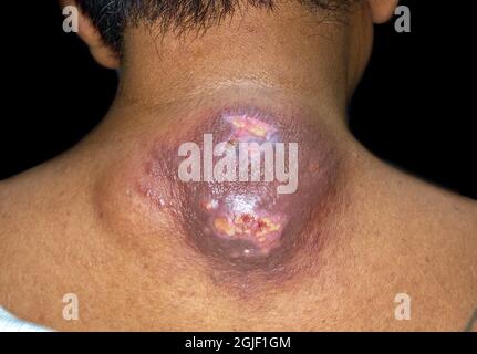 Großer Abszess mit umgebender Cellulitis oder Staphylokokken, Streptokokken-Hautinfektion am oberen Rücken eines männlichen asiatischen Patienten aus Burma. Stockfoto