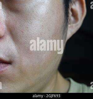 Schöne Haut mit breiten Poren im Gesicht von südostasiatischem, Myanmar oder koreanischem erwachsenen jungen Mann. Nahaufnahme. Stockfoto