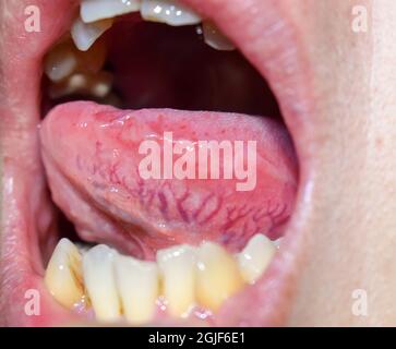 Markante, erweiterte und gewundene Venen, genannt Varices auf der lateralen Seite der Zunge. Nahaufnahme. Stockfoto