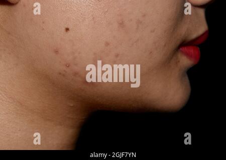 Chloasma oder Melasma, schwarze Flecken und Akne-Narben auf dem Gesicht der asiatischen jungen Frau. Nahaufnahme. Stockfoto