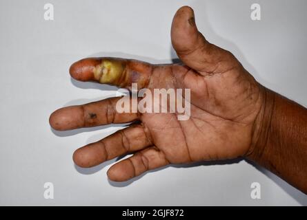 Abszess mit umgebender Cellulitis oder Staphylokokken, Streptokokken-Hautinfektion am Zeigefinger einer asiatischen burmesischen Patientin. Stockfoto