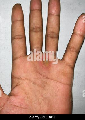 Abszess mit umgebender Cellulitis oder Staphylokokken-/Streptokokken-Hautinfektion bei einem männlichen asiatischen Patienten aus Burma. Isoliert auf grauem Hintergrund Stockfoto