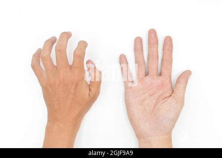 Krämpfe der Handmuskulatur beim asiatischen jungen Mann. Einseitige Flexion der Finger. Isoliert auf weißem Hintergrund. Stockfoto