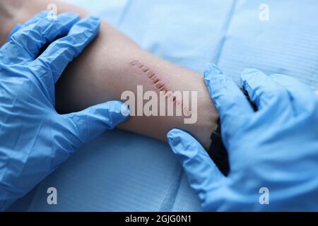 Arzt Chirurg in schützenden medizinischen Handschuhen Untersuchung Narbe auf Patienten Hand Nahaufnahme Stockfoto