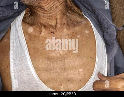 Alterungsstellen genannt Leberflecken, Nevi und weiße Flecken auf der Brust des asiatischen älteren Mannes. Stockfoto