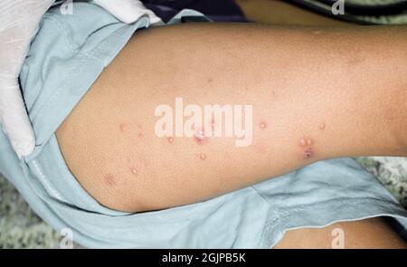 Kleine Vesikel, genannt Molluskum contagiosum im Oberschenkel des asiatischen Kindes. Stockfoto