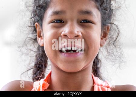 Nahaufnahme Mädchen Mund mit schiefen gebrochenen Zähnen und Odontolith Stockfoto