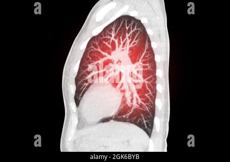 CT-Scan der sagittalen mip-Ansicht der Brust oder Lunge von Lungeninfektionen covid-19 mit Deckkraft des geschliffenen Glases. Stockfoto