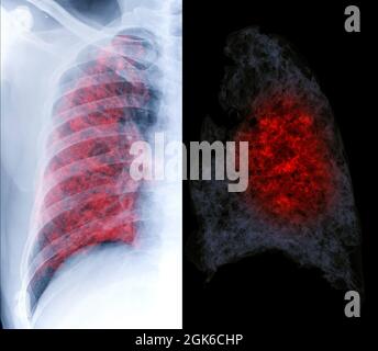 Vergleichen Sie die 3D-Darstellung der Thorax-Röntgenaufnahme und der CT-Thorax-Röntgenaufnahme, die eine Lungeninfektion von Covid-19 zeigt. Stockfoto