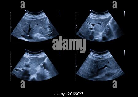 Ultraschall des oberen Abdomens mit Leber und Gallenblase zur Untersuchung von Leberzellkarzinom und Gallenstein. Stockfoto