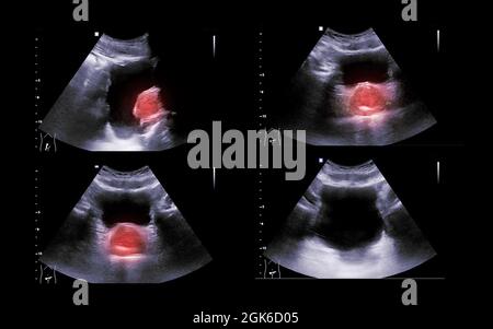 Ultraschall der Harnblase oder KUB zum Screening von Nieren- und Blasenerkrankungen. Stockfoto