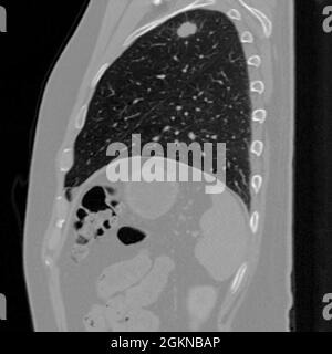 Seitenansicht Thorax-CT-Scan (Röntgen-Computertomographie) eines männlichen 54-jährigen Patienten. Im linken oberen Lappen seiner Lunge ist ein Tumor zu sehen Stockfoto