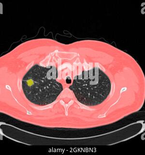 CT-Thoraxaufnahme (Röntgen-Computertomographie) eines männlichen 54-jährigen Patienten. Im linken oberen Lappen seiner Lunge ist ein Tumor zu sehen Stockfoto