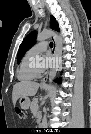 Röntgen-Computertomographie (CT) der Brustseitenansicht eines erwachsenen Mannes Stockfoto