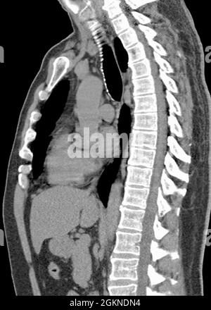 Röntgen-Computertomographie (CT) der Brustseitenansicht eines erwachsenen Mannes Stockfoto