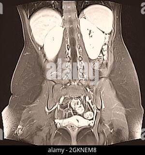 Enterography auch eine Magen-Darm-Studie oder Kontrast Radiographie des Magen-Darm-Trakt, genannt ist eine Serie von Röntgenaufnahmen t untersucht Stockfoto