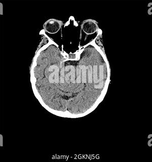 Kopf CT scan eines 85 Jahre alten weiblichen Patienten mit Anzeichen von Demenz Stockfoto