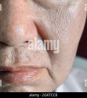 Vergrößerte Poren im Gesicht des südostasiatischen, chinesischen älteren Mannes mit Hautfalten. Stockfoto