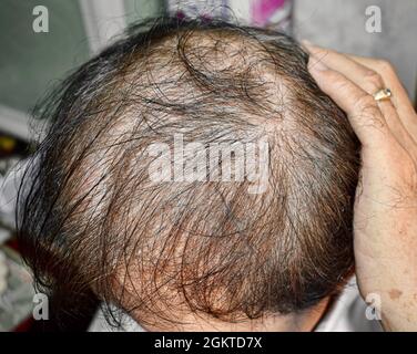 Dünner werdendes oder spärliches Haar, Haarausfall nach männlichem Muster im südostasiatischen, chinesischen älteren Mann. Stockfoto