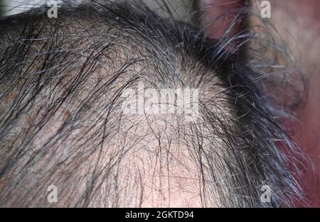 Dünner werdendes oder spärliches Haar, Haarausfall nach männlichem Muster im südostasiatischen, chinesischen älteren Mann. Stockfoto