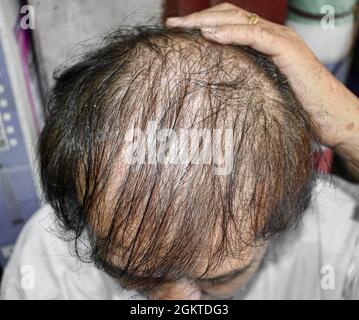 Dünner werdendes oder spärliches Haar, Haarausfall nach männlichem Muster im südostasiatischen, chinesischen älteren Mann. Stockfoto