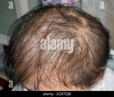 Dünner werdendes oder spärliches Haar, Haarausfall nach männlichem Muster im südostasiatischen, chinesischen älteren Mann. Stockfoto