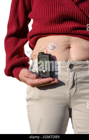 Frau, die wegen ihres Diabetes eine mobile medtronic Insulinpumpe trägt Stockfoto