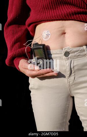 Frau, die wegen ihres Diabetes eine mobile medtronic Insulinpumpe trägt Stockfoto