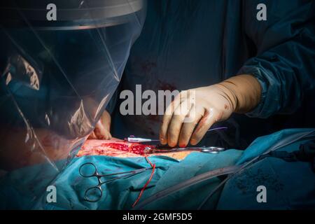 In einem Operationssaal wird eine Gefäßoperation durchgeführt Stockfoto