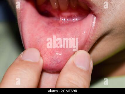 Kleine Vesikelläsion an der Unterlippe des asiatischen Mannes. Stockfoto