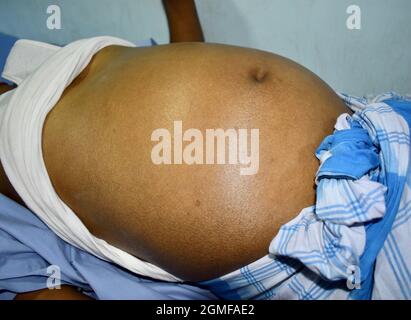 Bauchfett bei Patienten mit ascities. Flanke ist voll. Stockfoto