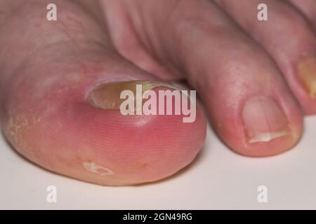 Eingewachsene Zehennagel-Onychocryptose auf kaukasischen Großzehe Hallux, verursacht durch Pilzinfektion Tinea unguium. Makro-abgewinkelte Ansicht mit kleineren Ziffern sichtbar. Stockfoto