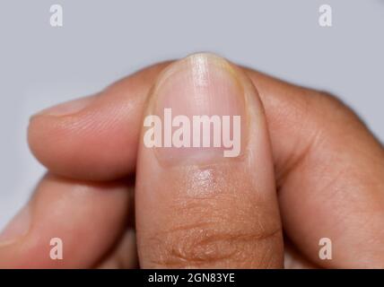 Kleine oder fehlende Lunula oder Halbmonde am Fingernagel mit Längslinien bei asiatischer junger Frau. Stockfoto