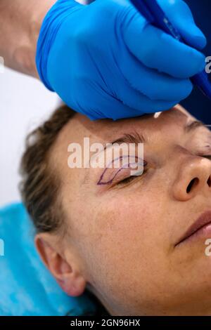 Chirurg zeichnet Linie auf Mädchen Auge mit Marker Vorbereitung für das Verfahren. Stockfoto