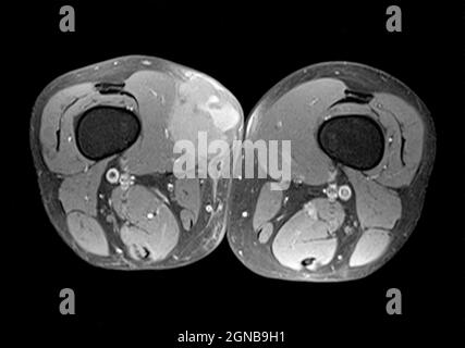 MRI (Magnetic Resonance Imaging) eines bösartigen Tumors (Sarkom), die sich an der rechten Hüfte ein männlicher Patient Stockfoto