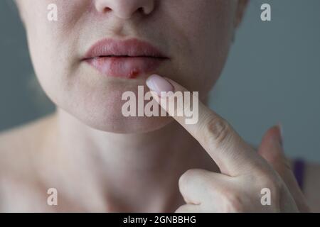 Die Frau mit einem Virus Herpes auf den Lippen Stockfoto