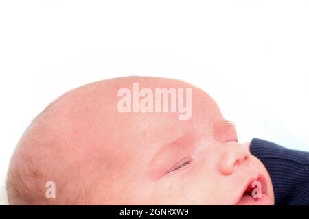 Das Detail des Kopfes des unglücklich weinenden neugeborenen Jungen mit Hautproblemen. Er hat Seborea und Akne. Stockfoto