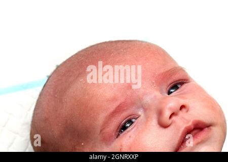 Das Detail des Kopfes des unglücklich weinenden neugeborenen Jungen mit Hautproblemen. Er hat Seborea und Akne. Stockfoto