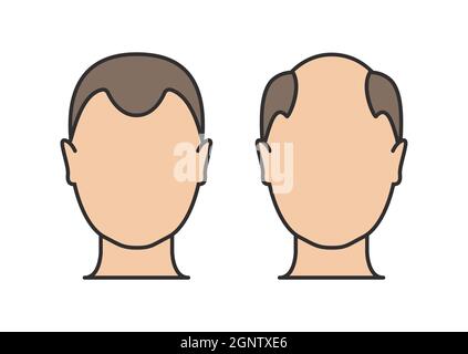 Haarausfall Mann Symbol Cartoon Vektor-Logo. Haarausfall männliche Kopfhautkahl Abbildung Stock Vektor